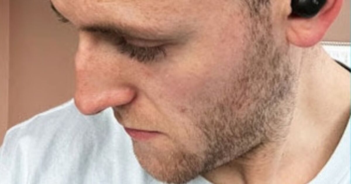 Bald man dumped by date has transplant and is unrecognisable 2 years later