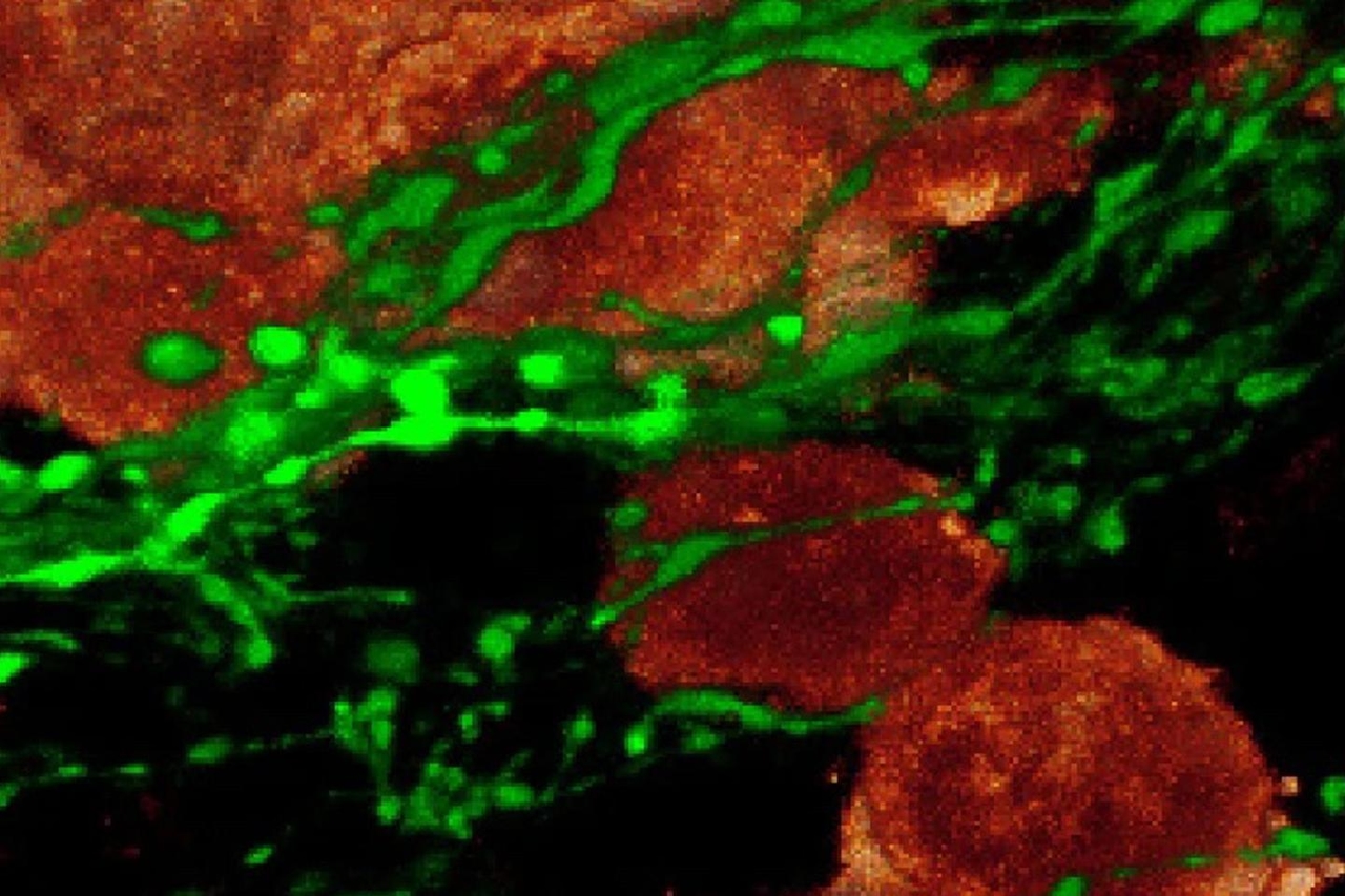 Come i tumori polmonari dirottano il sistema nervoso e immunitario