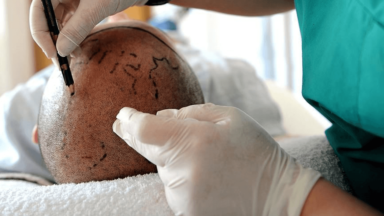 He came to Istanbul from England for a hair transplant and died! An investigation has been launched.
