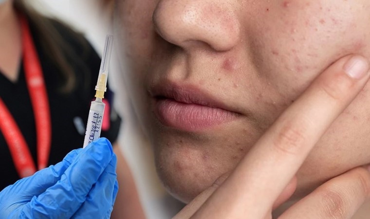 Een primeur in de wereldgeschiedenis: ‘Acne-vaccin’ in ontwikkeling