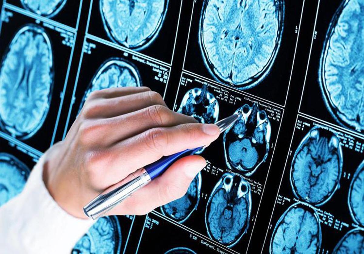 Demans, makine öğrenimi ve algoritmalar Alzheimer'ın başlangıcını tahmin ediyor
