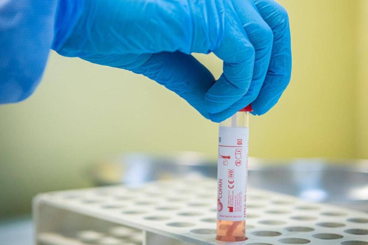 Research, Long Covid genetics revealed: a variant increases the risk by 60%